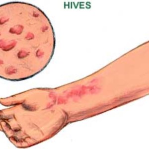 Urticaria, commonly known as Hives
